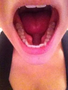 torus mandibular