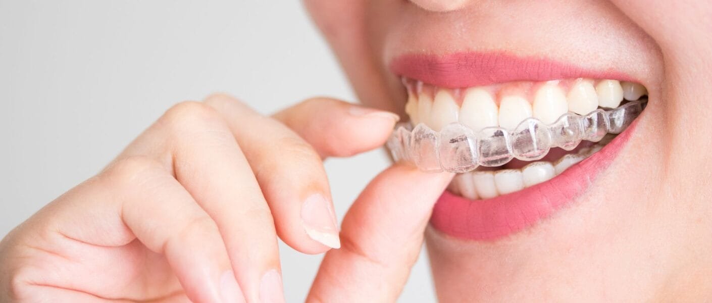 invisalign o que é