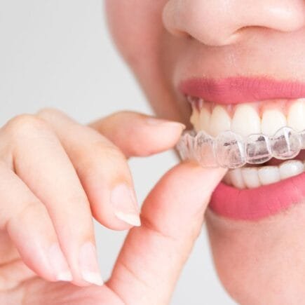 invisalign o que é
