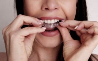 aparelho ortodôntico estético