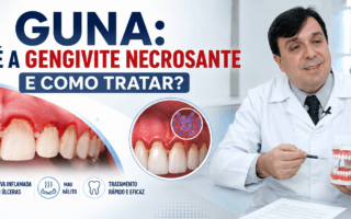 GUNA Entenda a Gengivite Necrosante