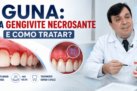 GUNA Entenda a Gengivite Necrosante