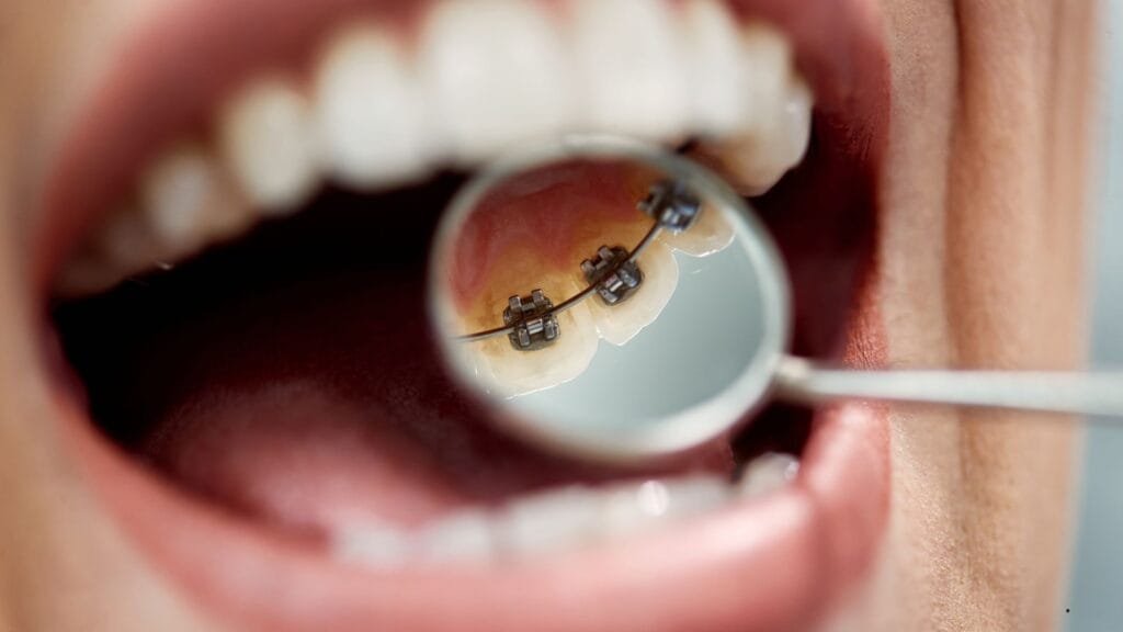 aparelho lingual, O Aparelho Lingual Invisível Dói? Como Funciona o Aparelho Lingual na Ortodontia? Aparelho Interno Sublingual, O que é Aparelho Lingual. como o aparelho lingual,