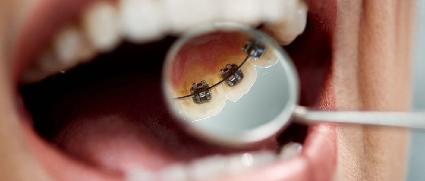 aparelho lingual, O Aparelho Lingual Invisível Dói? Como Funciona o Aparelho Lingual na Ortodontia? Aparelho Interno Sublingual, O que é Aparelho Lingual. como o aparelho lingual,