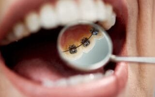 aparelho lingual, O Aparelho Lingual Invisível Dói? Como Funciona o Aparelho Lingual na Ortodontia? Aparelho Interno Sublingual, O que é Aparelho Lingual. como o aparelho lingual,