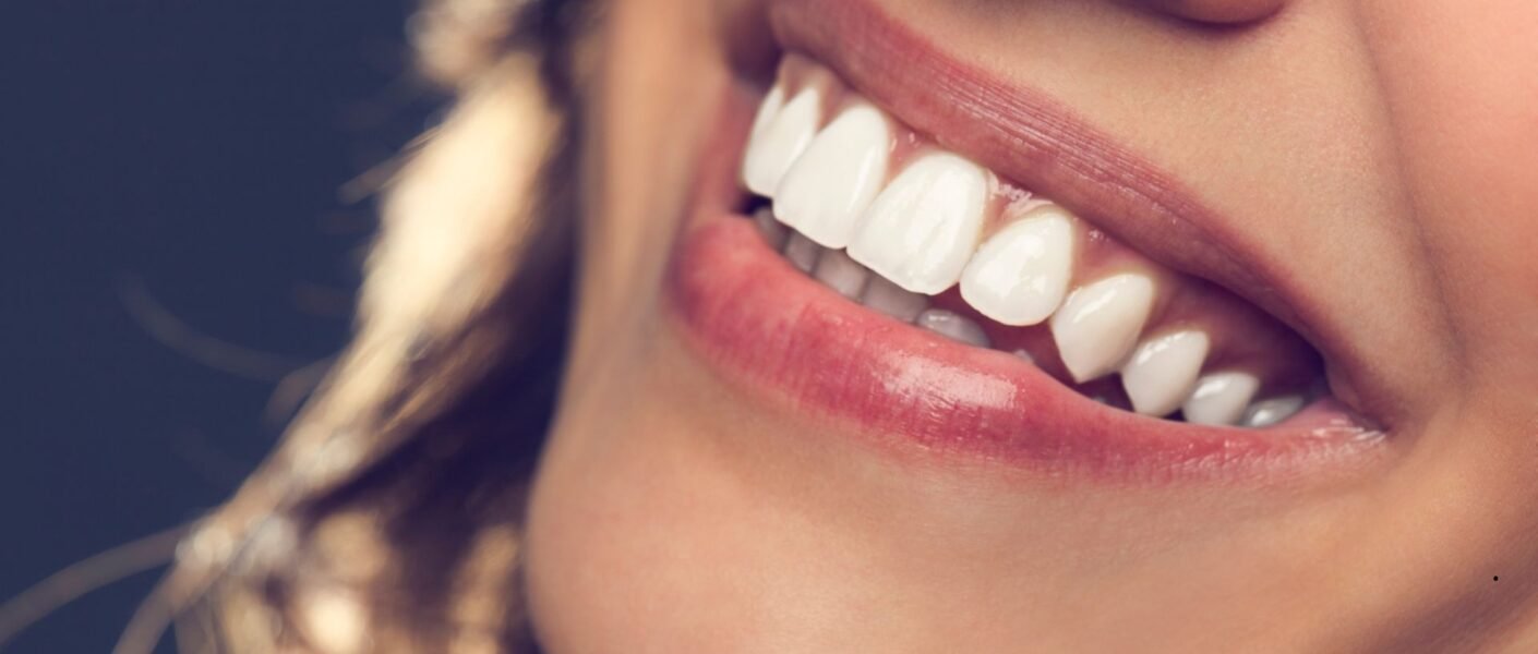 Aparelho Autoligado Preço