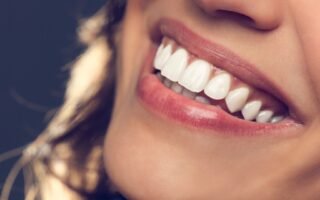 Aparelho Autoligado Preço