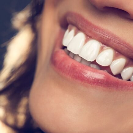 Aparelho Autoligado Preço