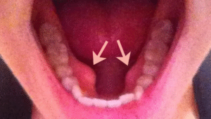 Tórus Mandibular