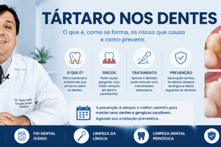 Tártaro nos Dentes