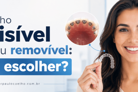 Aparelho invisível fixo ou removível