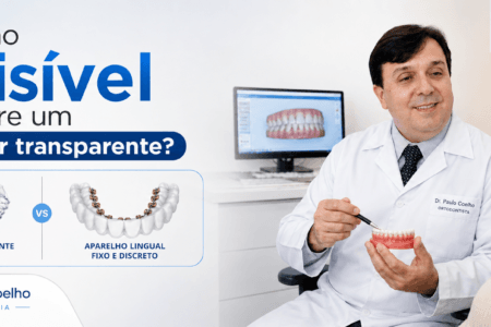 aparelho invisível é alinhador transparente
